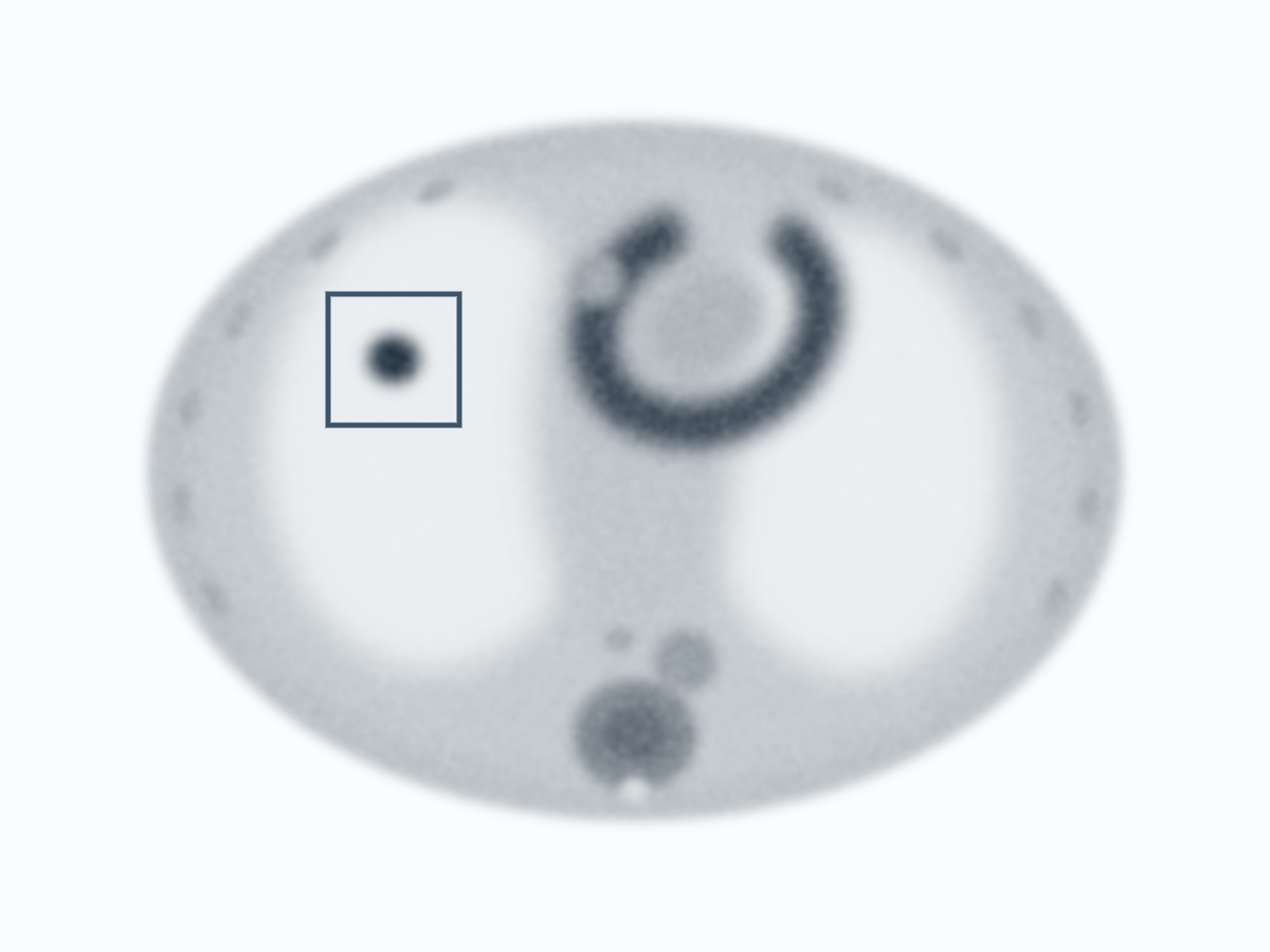 Synthetic PET scan with an AI-flagged finding